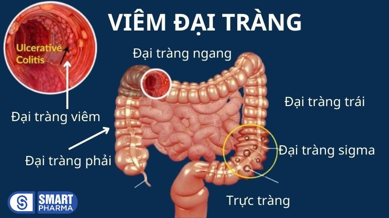 Viêm đại tràng là bệnh dễ mắc phải ở người Việt