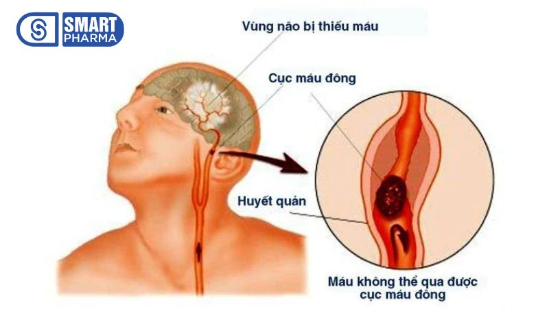 Cục máu đông ở não gây đau đầu, méo miệng,... thậm chí đột quỵ