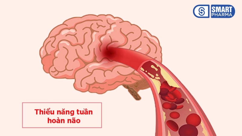 Thiểu năng tuần hoàn não (hay còn gọi là rối loạn tuần hoàn não)