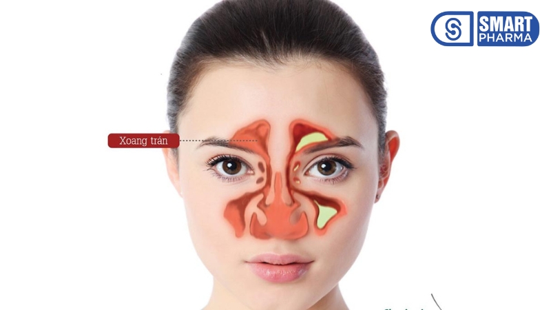 Smart Pharma - Dấu hiệu viêm xoang và cách phòng ngừa 2 Smart Pharma - 1 4