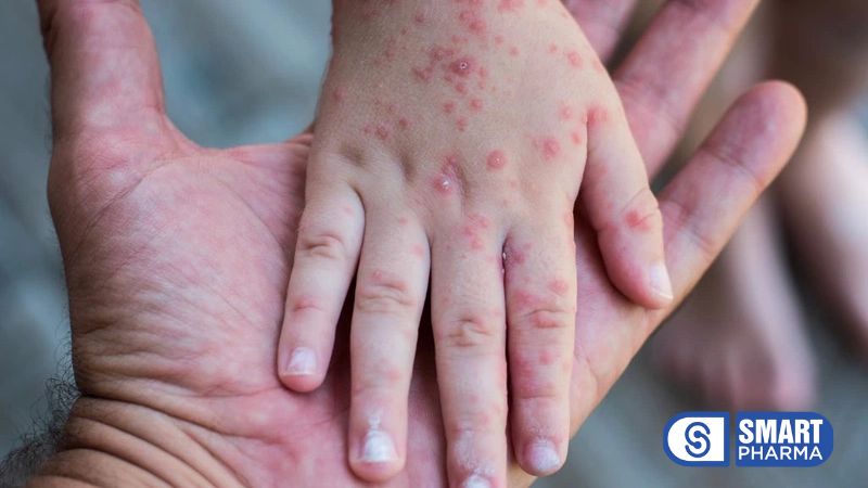 Smart Pharma - Bệnh sởi: Dấu hiệu, nguyên nhân và cách điều trị 2 Smart Pharma - 1 5