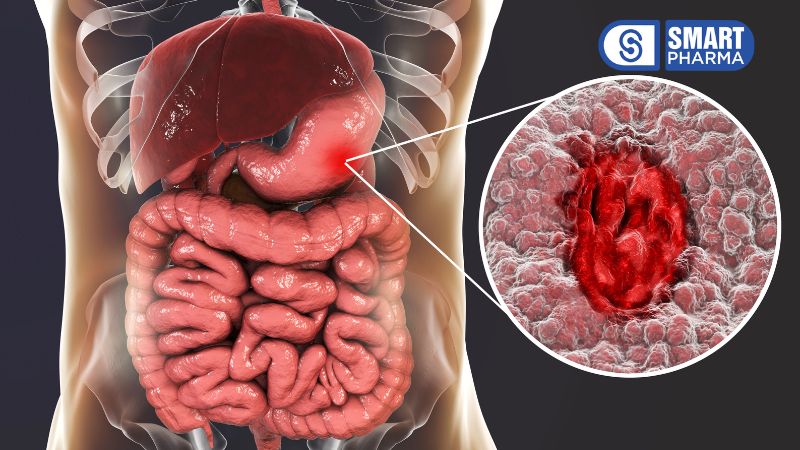 Viêm loét đại tràng (Ulcerative Colitis – UC) là một bệnh viêm ruột (IBD) gây ra tình trạng viêm và loét ở lớp niêm mạc đại tràng