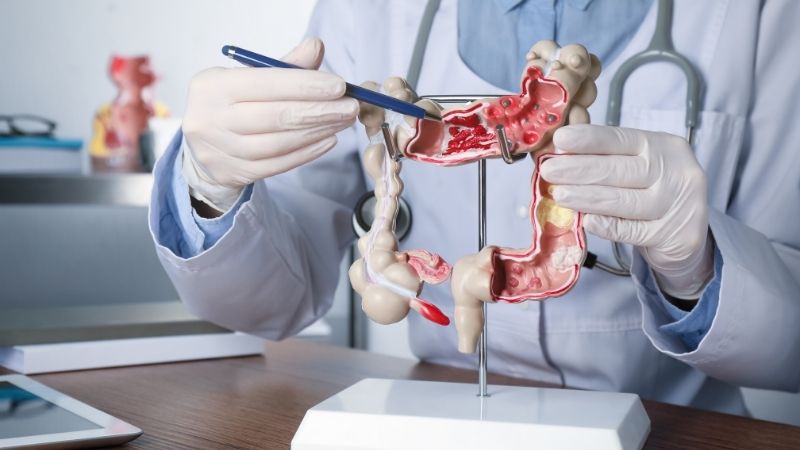 Hội chứng ruột kích thích (IBS - Irritable Bowel Syndrome) là một rối loạn tiêu hóa mạn tính