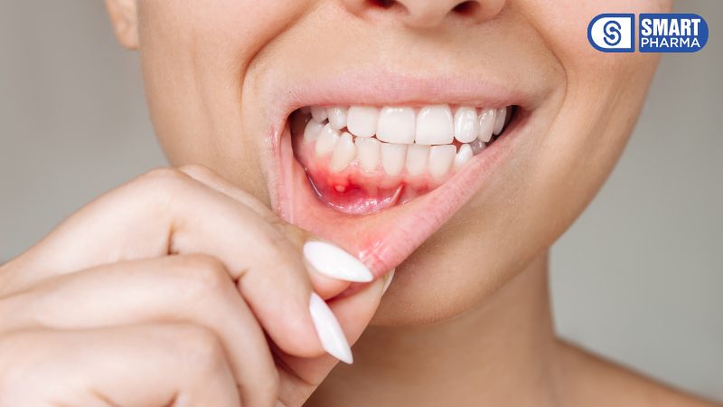 Nhiệt miệng (hay còn gọi là loét áp-tơ) là những vết loét nhỏ, nông, có màu trắng, vàng hoặc đỏ xuất hiện trong khoang miệng