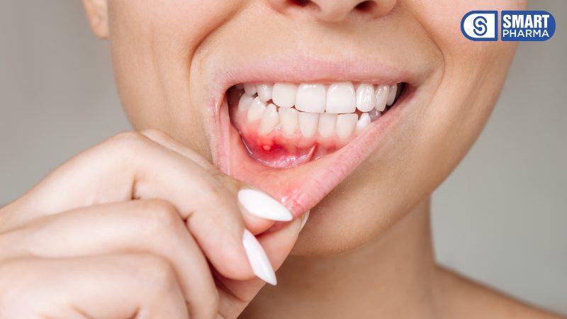 Smart Pharma - Nhiệt miệng – Căn bệnh tưởng nhỏ nhưng gây khó chịu lớn trong mùa đông 1 Smart Pharma - 1 1 1