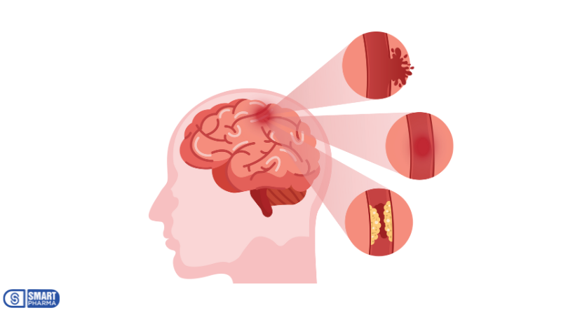 Smart Pharma - 10 dấu hiệu tai biến ai cũng cần biết để xử lý kịp thời 1 Smart Pharma - 1