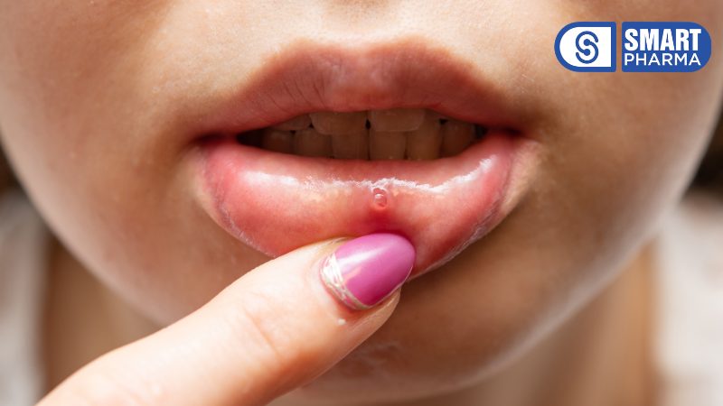 Smart Pharma - Rằm tháng Giêng: Ăn chay không chỉ thanh tâm mà còn cực kỳ có lợi cho sức khỏe 4 Khi cơ thể không đào thải độc tố hiệu quả, các biểu hiện như mụn nhọt, mẩn ngứa hoặc nhiệt miệng có thể xuất hiện.