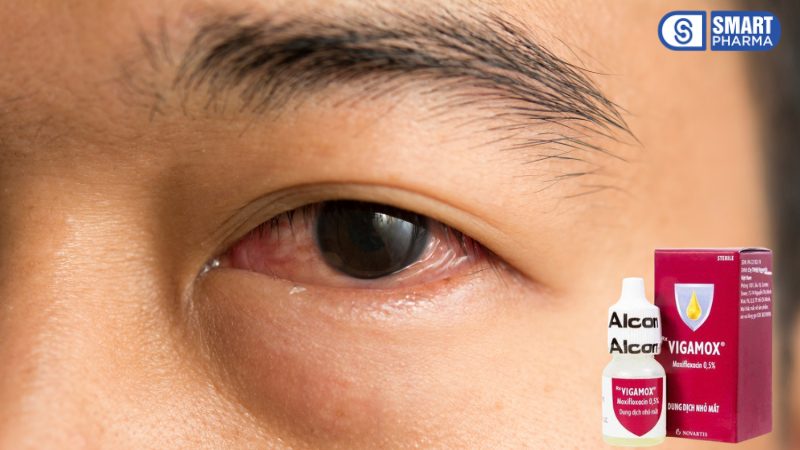 Smart Pharma - Viêm kết mạc mắt: Nguyên nhân, triệu chứng và cách điều trị hiệu quả 3 Smart Pharma - 6 2