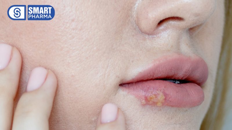 Smart Pharma - Viêm kết mạc mắt: Nguyên nhân, triệu chứng và cách điều trị hiệu quả 4 Smart Pharma - 8