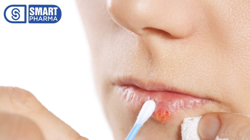 Smart Pharma - Viêm kết mạc mắt: Nguyên nhân, triệu chứng và cách điều trị hiệu quả 6 Smart Pharma - 9